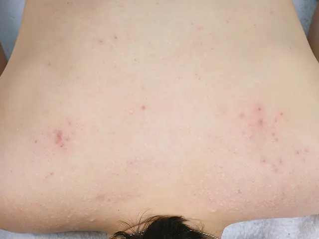 背中の肌荒れには3種類があります