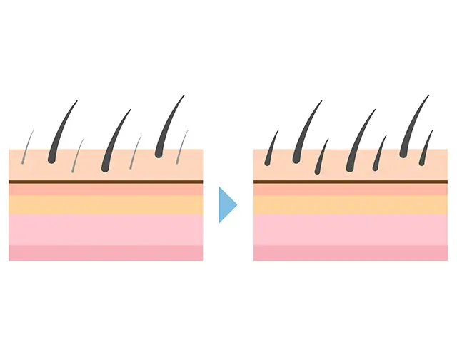 硬毛化や多毛化は脱毛方法と関係があります