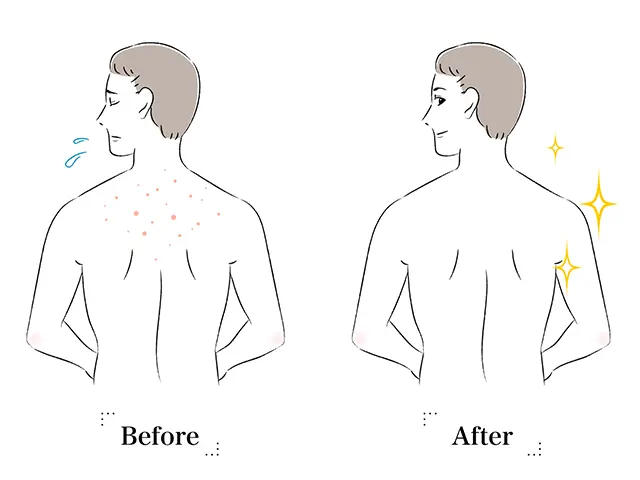 背中の脱毛をすることで見栄えがします