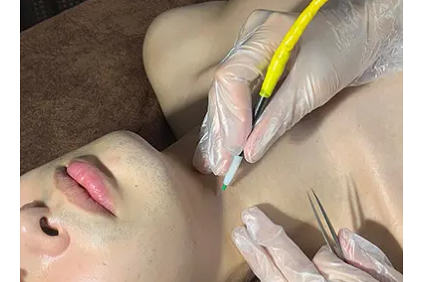 飲酒で肌トラブルが出やすい方はニードル脱毛も選択肢