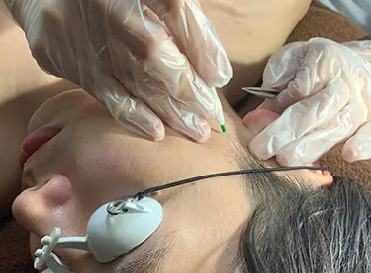 メンズのもみあげ脱毛の主な施術方法